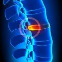 Top Tips for Slipped Disc Relief