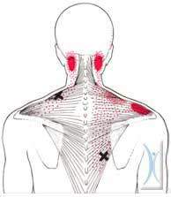 chiropractic for neck pain addresses muscle dysfunction. Dynamic Health Jersey CI